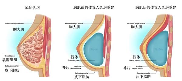 假体置入乳房重建术.jpg