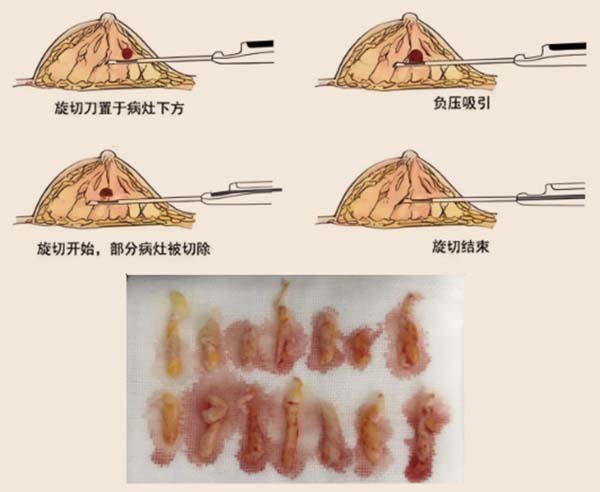 乳腺结节微创旋切术.jpg