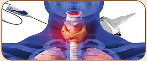 甲状腺射频消融术.jpg