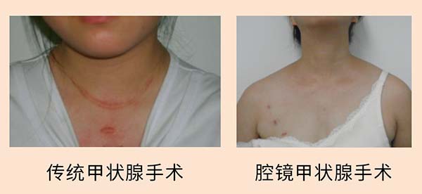 腔镜辅助下甲状腺癌根治术 甲状腺结节切除.jpg