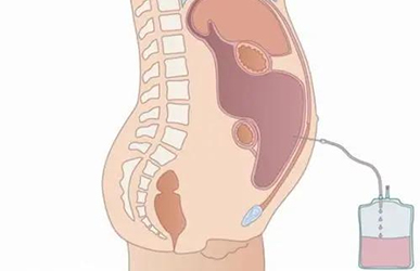 腹腔穿刺术
