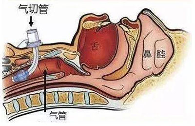 气管切开术