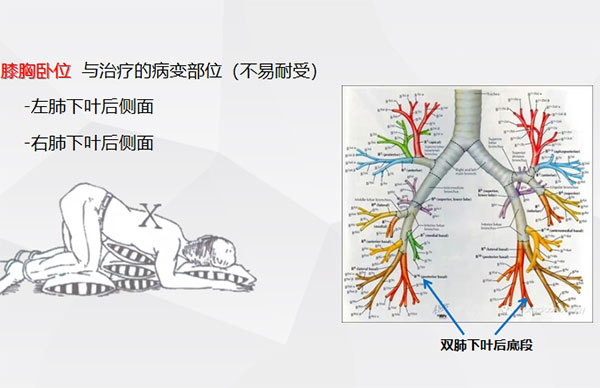 体位引流及排痰科普