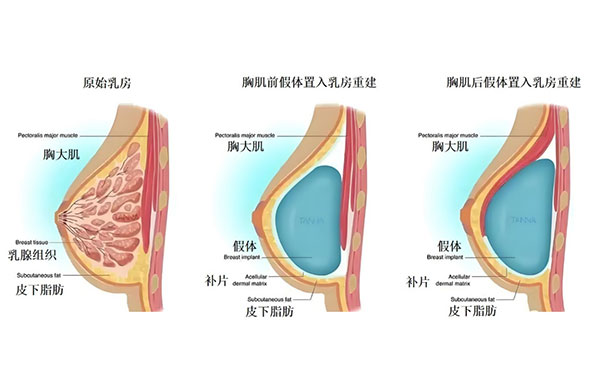 假体置入乳房重建术