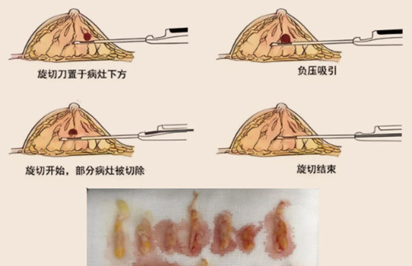 乳腺结节微创旋切术