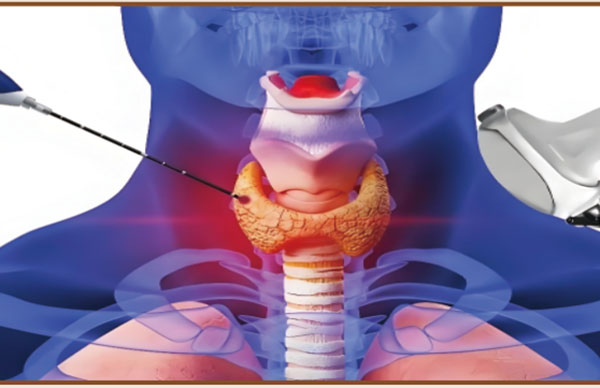甲状腺射频消融术