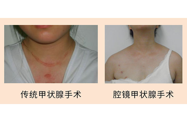 腔镜辅助下甲状腺癌根治术/甲状腺结节切除